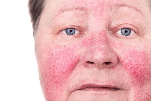 Deri Döküntüleri ve Rosacea'ya neden olur