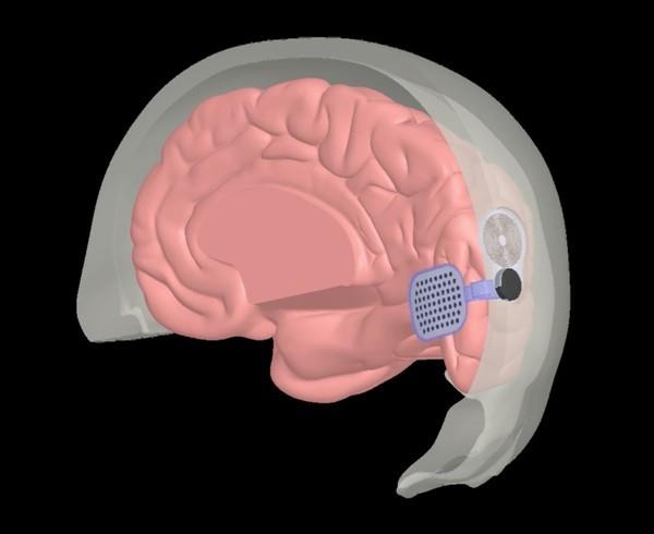 Πειραματικό εμφύτευμα μπορεί να αποκαταστήσει την όραση σε τυφλά άτομα εμφύτευμα στον εγκέφαλο