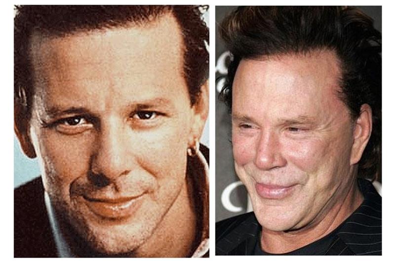 mickey rourke beauty op